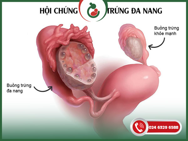 buong trung da nang van co thai tu nhien duoc khong buong trung da nang van co thai tu nhien duoc khong