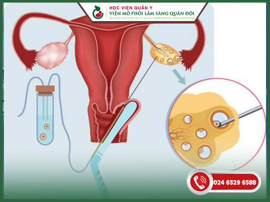 ivf là gì giá bao nhiêu