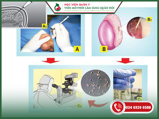cách lấy tinh trùng