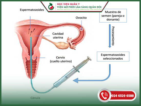 quy trình bơm tinh trùng