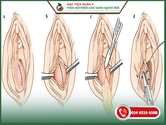 điều trị viêm tuyến bartholin