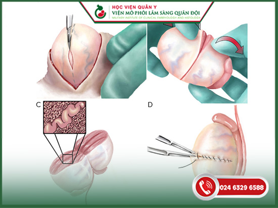 phương pháp micro tese