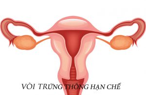 Hình ảnh vòi trứng thông hạn chế 