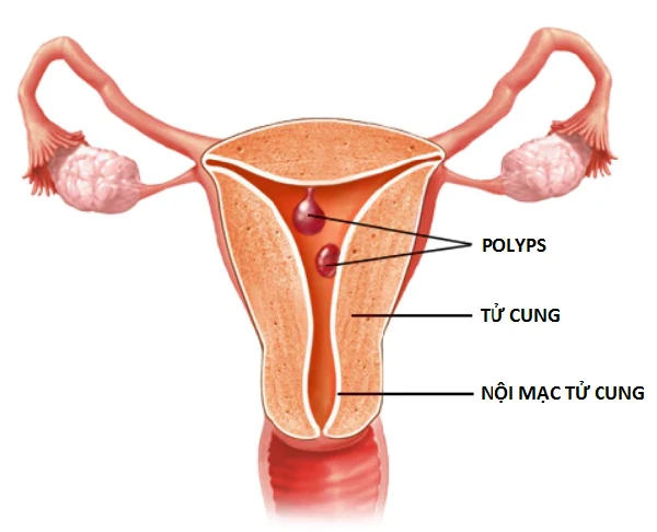 polyp 1