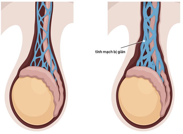 gian tinh mach thung tinh