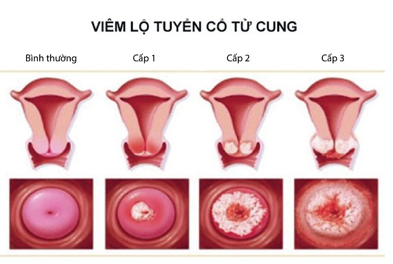 phuong phap ap lanh dieu tri viem lo tuyen khi nao nen ap dung