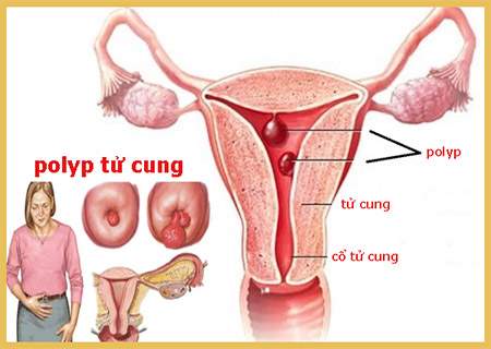 polyp co tu cung