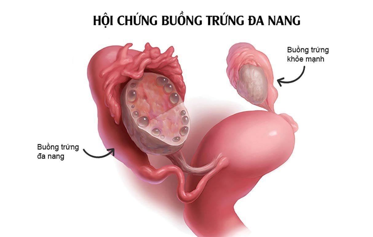 hoi chung buong trung da nang la gi 2