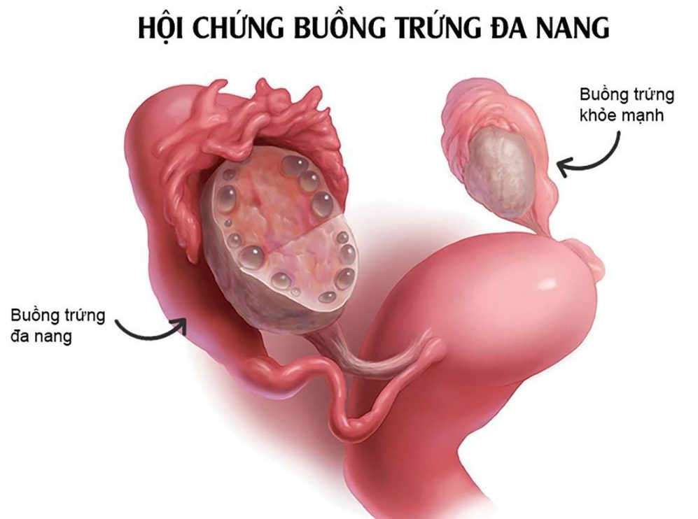 hoi chung buong trung da nang la gi 2