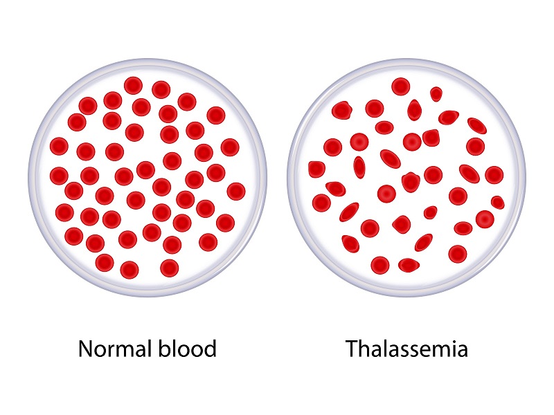 thalassemia gentis 8 2020 5