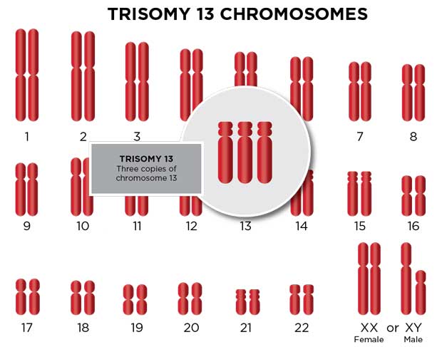 trisomy 13 chromosomes