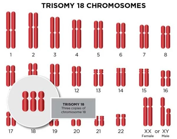 trisomy 18 chromosomes 1 e1665929515248.jpg