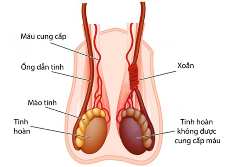 20220210 chan doan va dieu tri xoan tinh hoan 1