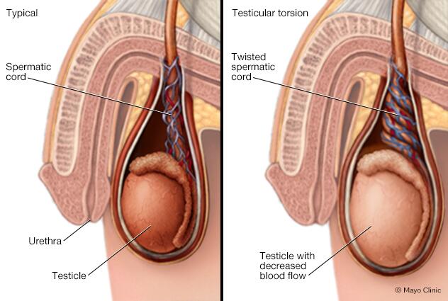 testicular torsion