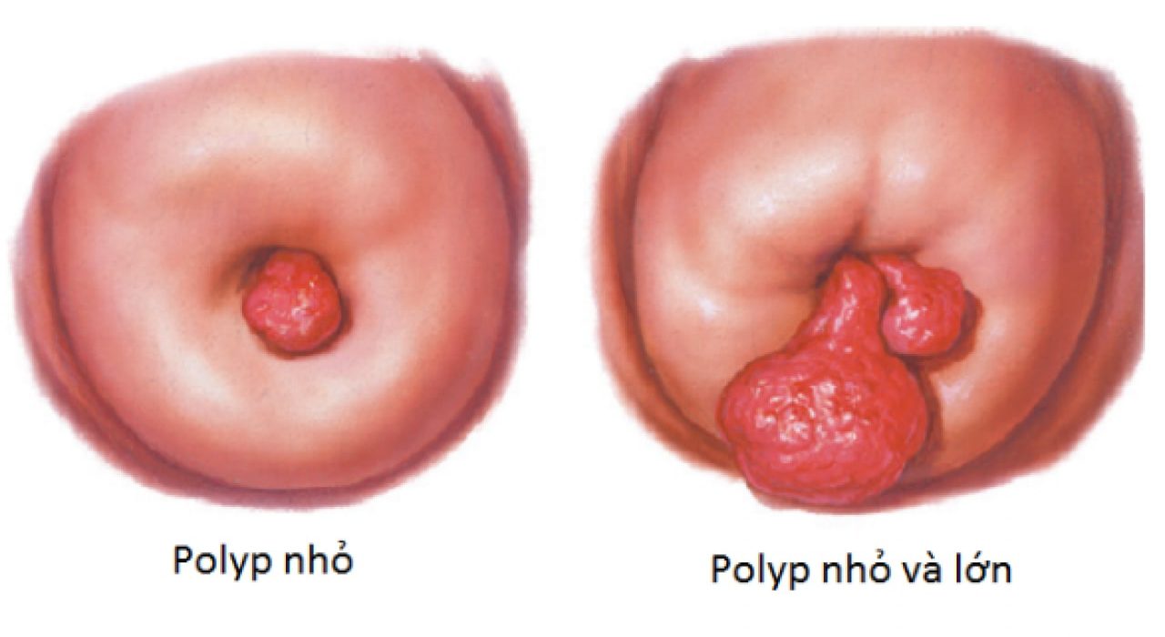 hinh dang polyp