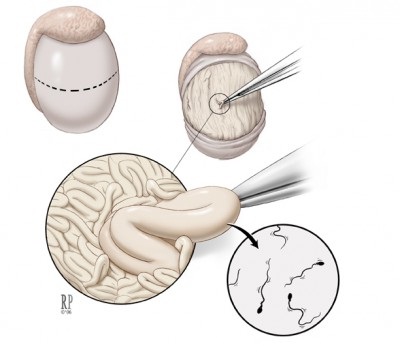 sperm retrieval 2