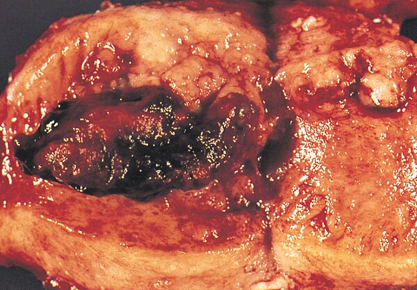 Endometrial adenocarcinoma gross