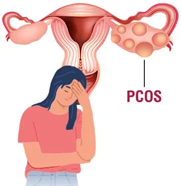 PCOS 0.jpg
