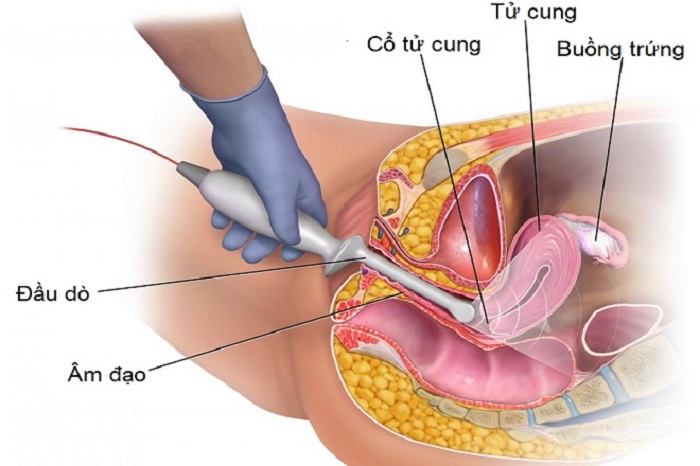 sieu am dau do 03