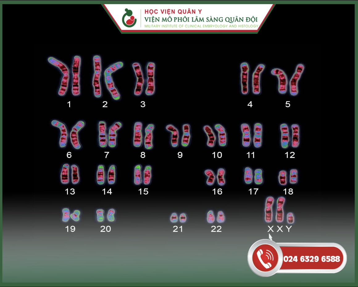 hoi chung klinefelter xxy do thua 1 nst x Anh chup Man hinh 2025 02 21 luc 14.55.51