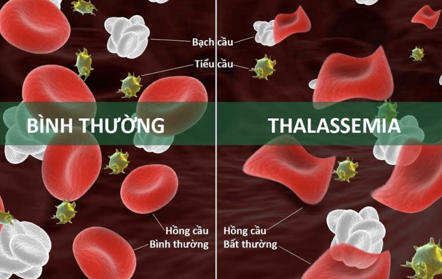 Thalassemia Thalassemia