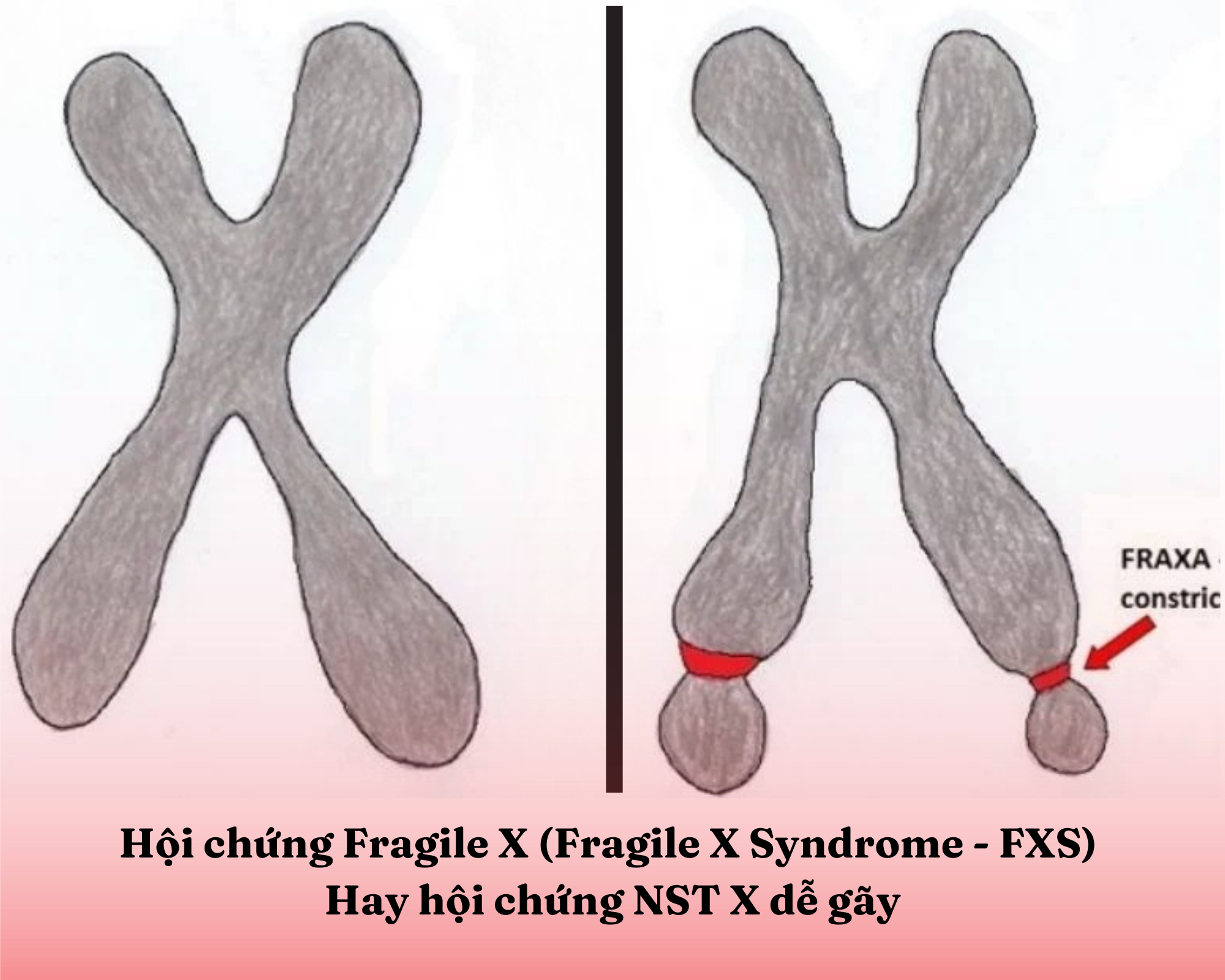 Hội chứng fragile x Hội chứng fragile x