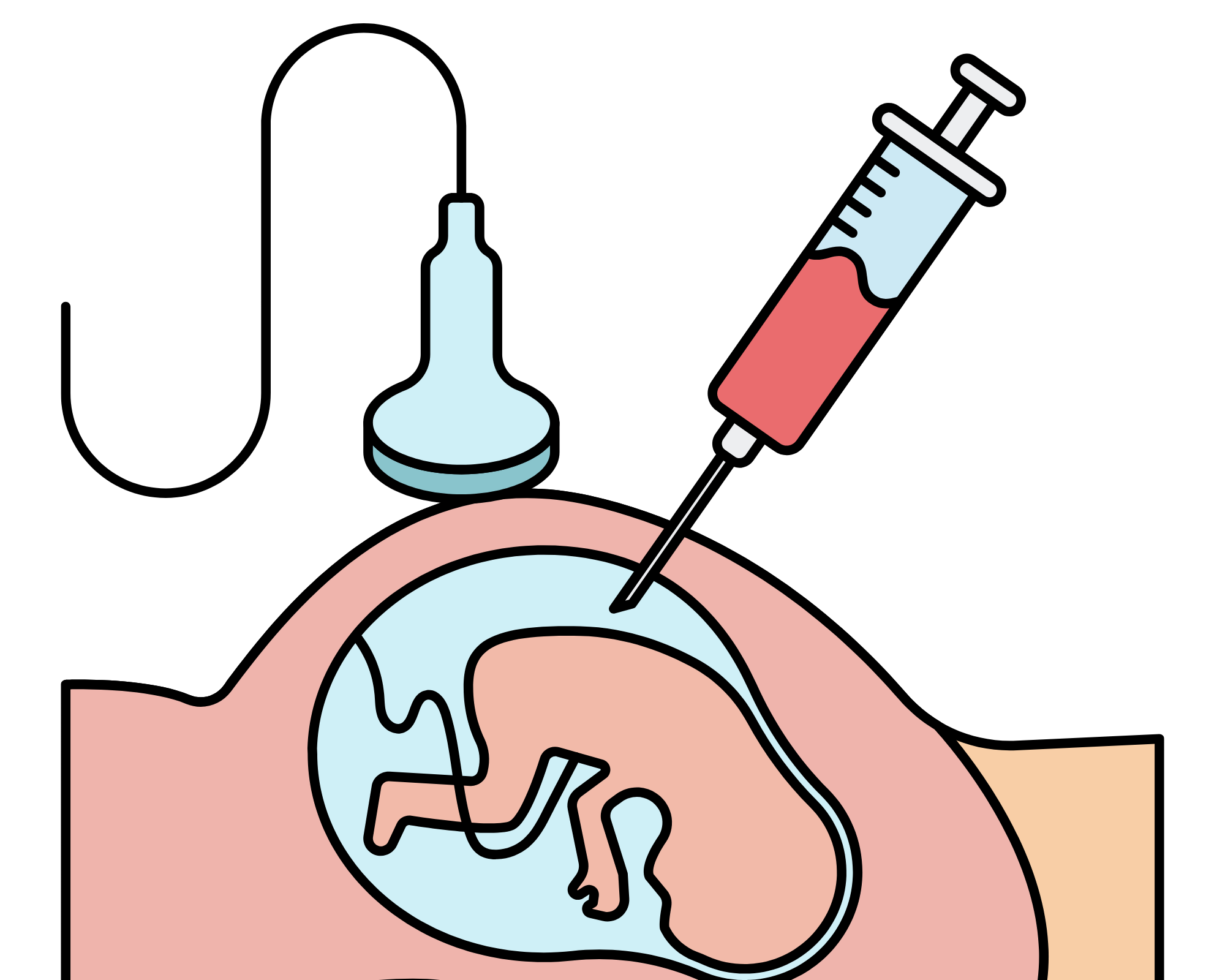 chọc ối chọc ối