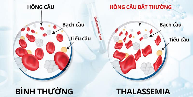 Thalassemia Thalassemia