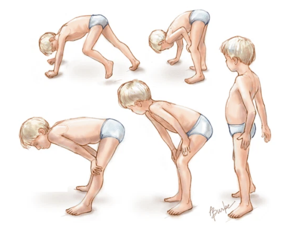 Loạn dưỡng cơ Duchenne