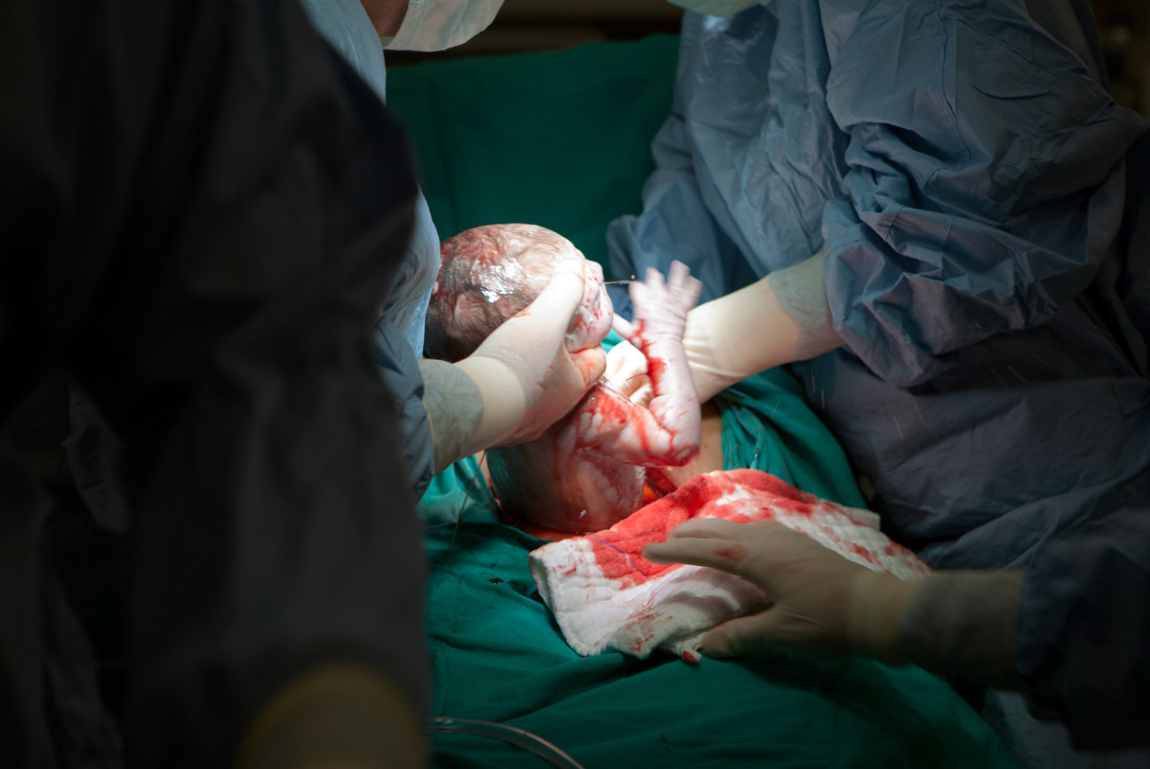 giai dap thac mac sinh thuong va sinh mo cai nao dau hon 1 06460e9e36.jpg Hiện nay tại Việt Nam, tỷ lệ các ca sinh mổ ngày càng tăng.