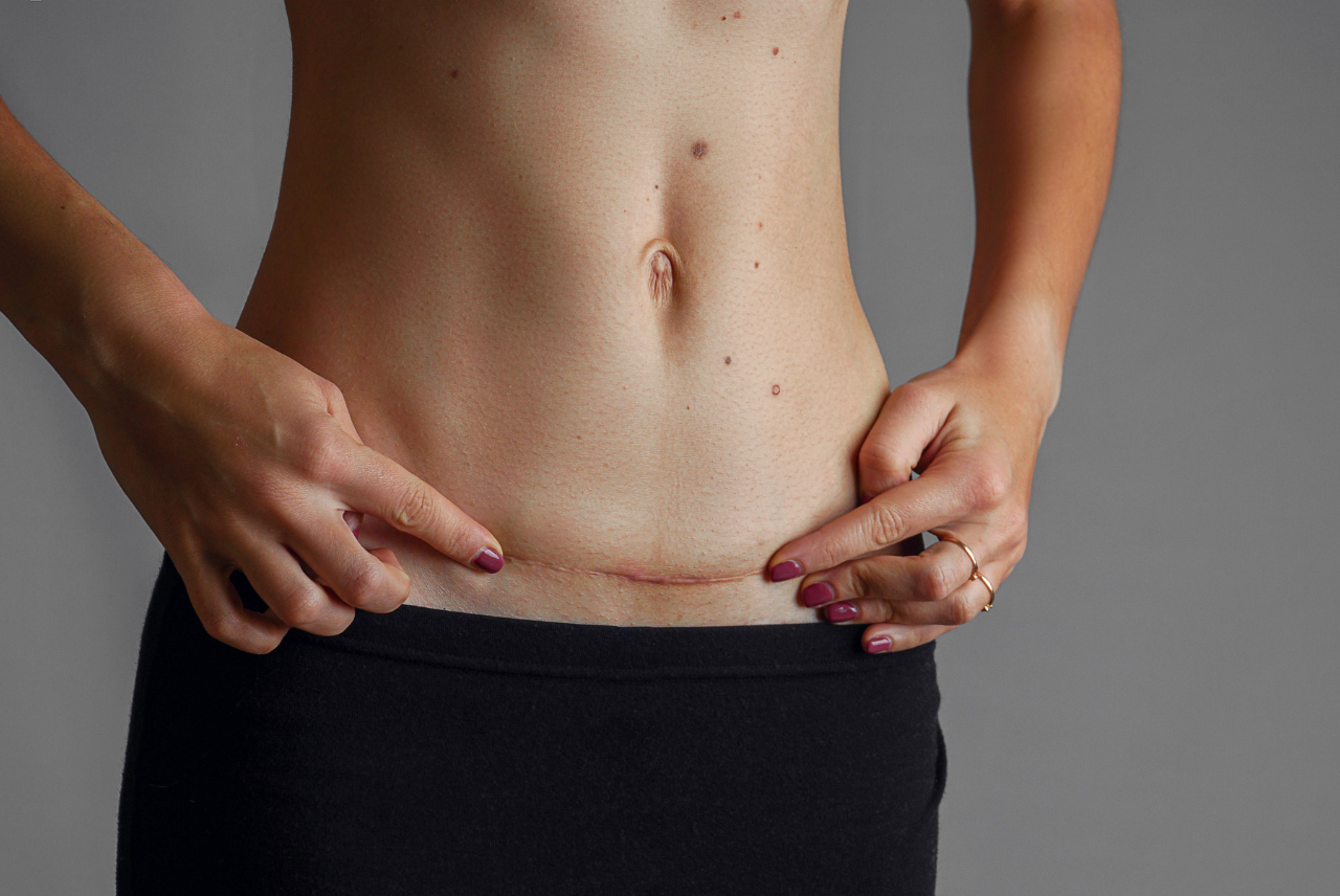 Vết mổ Vết mổ