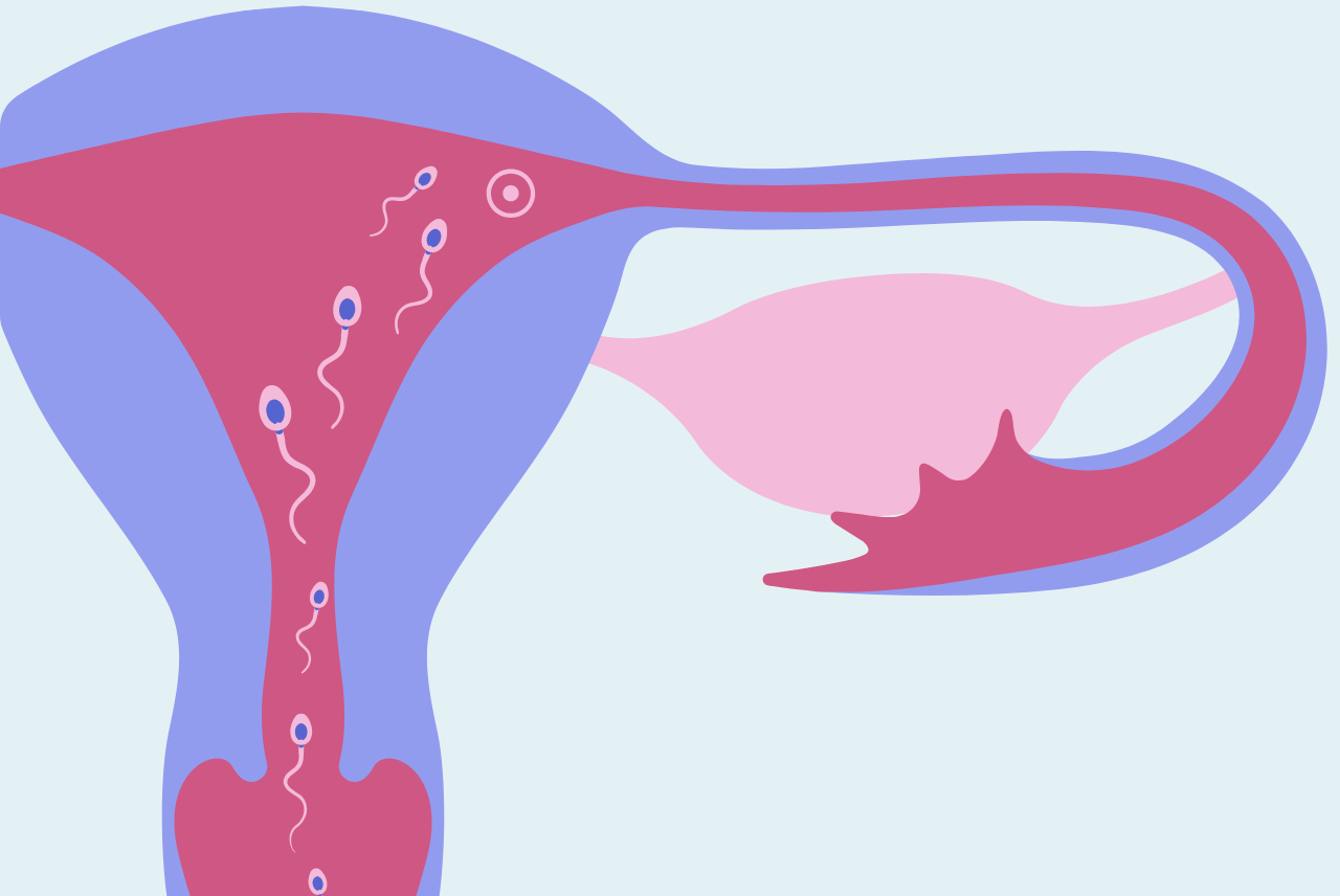 Thụ tinh nhân tạo – IUI là phương pháp bơm tinh trùng vào buồng tử cung