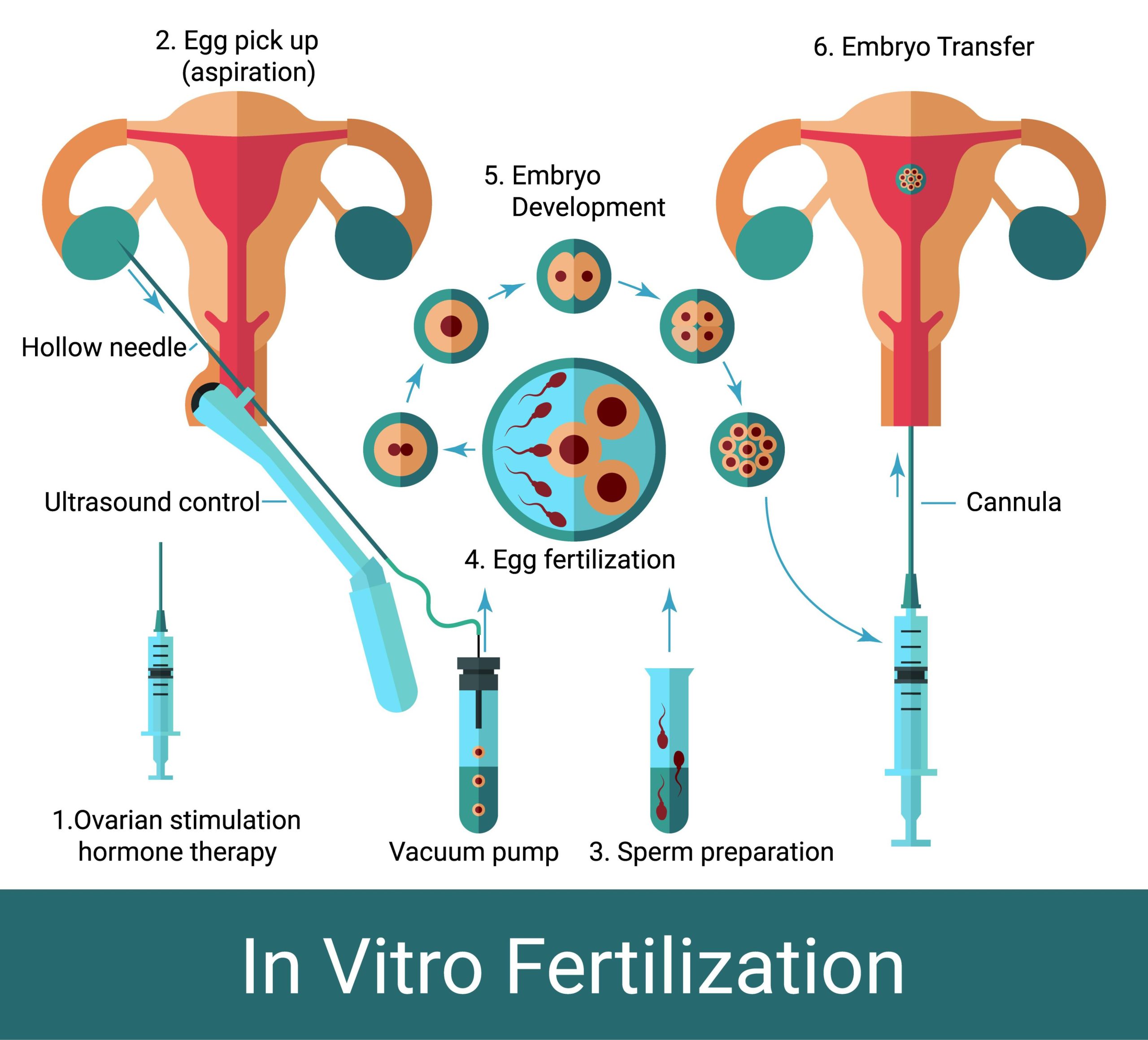 IVF IVF