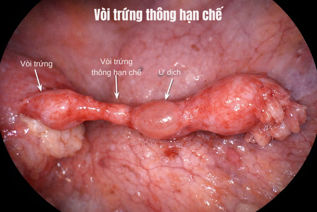 Vòi trứng hạn chế