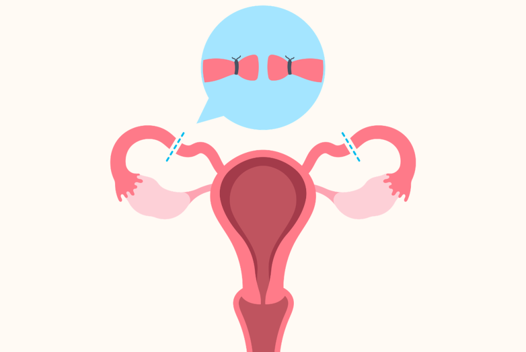 Đã thắt vòi trứng có làm IVF được không?