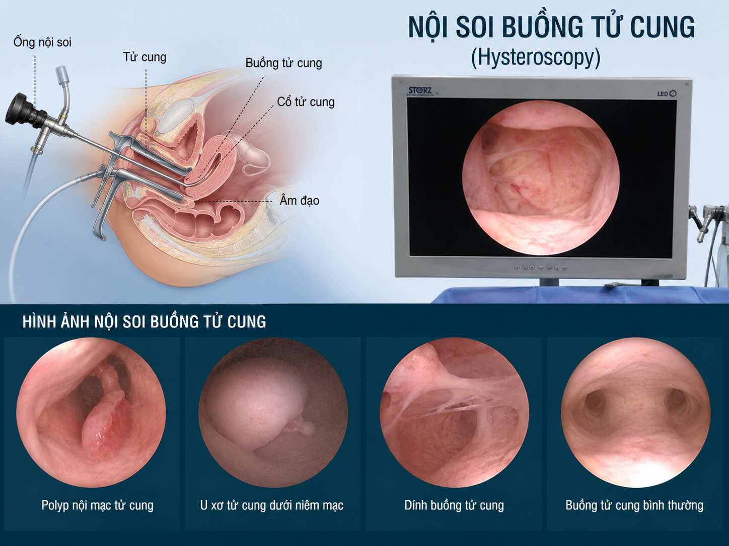 Soi buồng TC Soi buồng TC