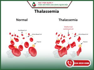 Hội chứng Thalassemia