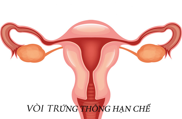 Hình ảnh vòi trứng thông hạn chế