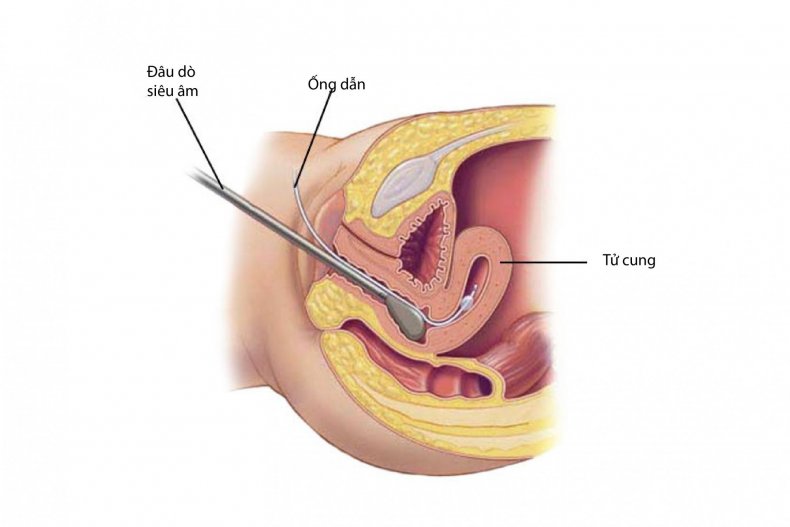 sieu am bom nuoc long tu cung 01