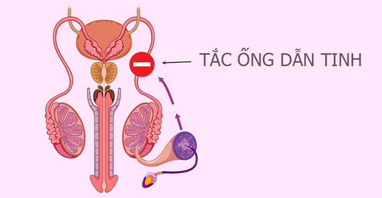 benh tac ong dan tinh 3