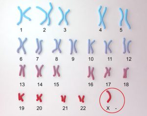 hoi chung turner nguyen nhan bieu hien dieu tri ra sao 1 1 8bf09b7bd2
