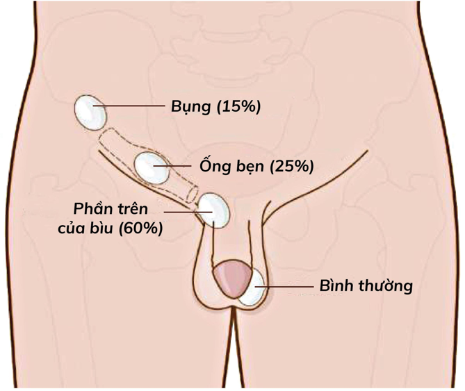 tinh hoan an vo sinh1.jpg 2