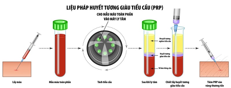 20230609 huyet tuong giau tieu cau 2