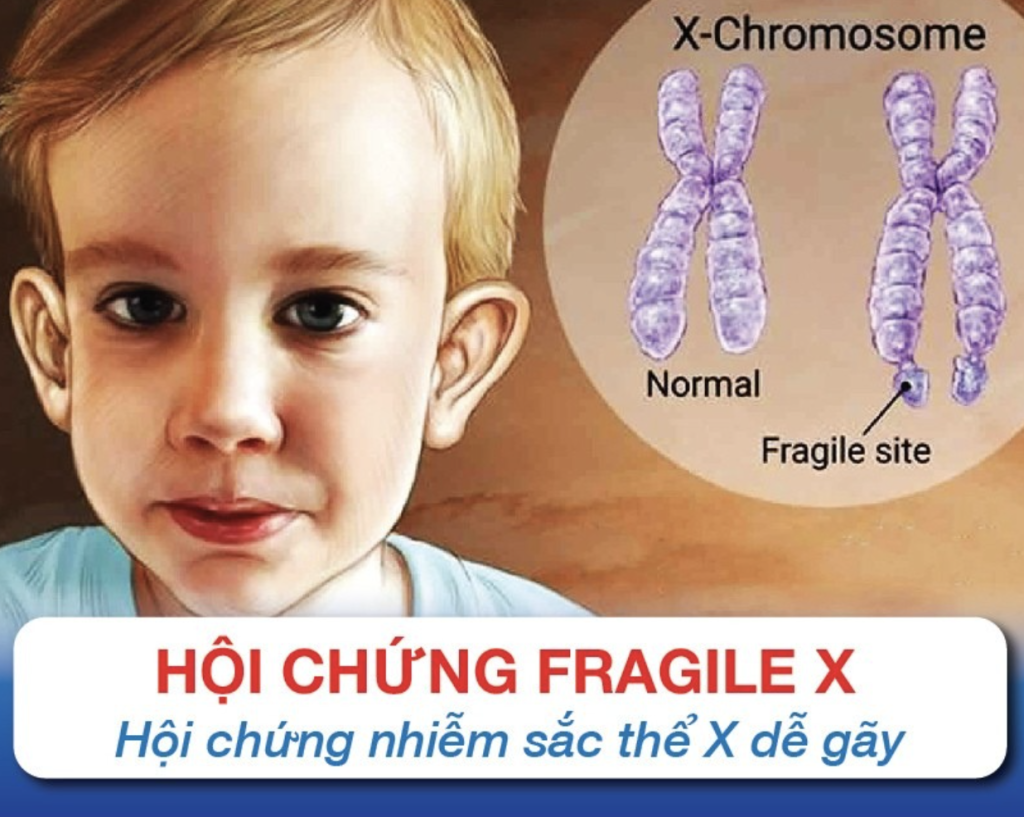 Hội chứng Fragile X