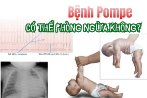 Bệnh Pompe có thể phòng ngừa không?